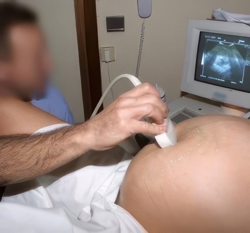 PMI - Un gynécologue condamné pour la naissance d'une enfant infirme